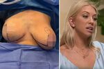 US reality star Stassi Schroeder reveals graphic breast redu